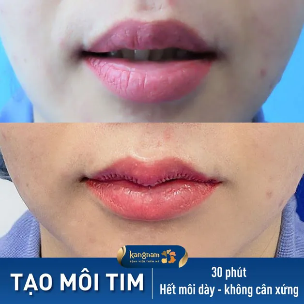 Cắt môi trái tim không đau