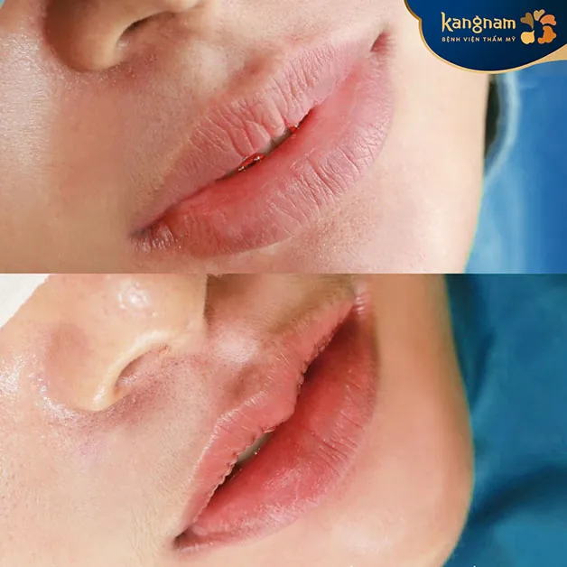 Người có nhiều khuyết điểm về môi như môi dày, môi mỏng, môi lệch