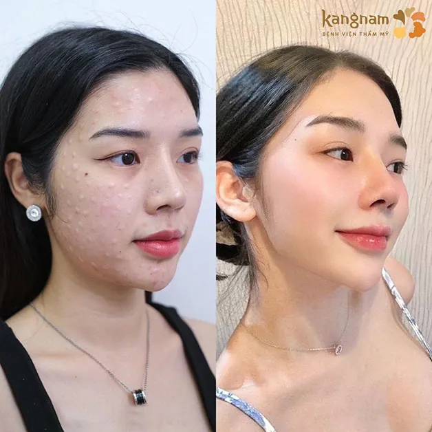 Tiêm meso giúp làn da căng bóng, láng mịn