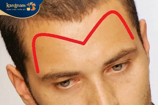 Trán chữ M là hình dạng tóc trên vầng bị thưa và không đều đặn