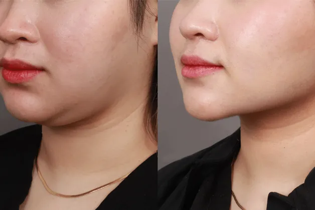 Loại bỏ mỡ tích tụ ở vùng cằm, cổ, mang tai và má