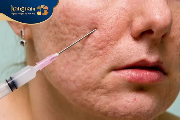 Phương pháp bóc tách đáy sẹo