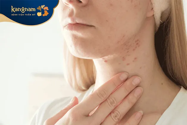 mụn mọc ở cổ xuất hiện dưới nhiều dạng khác nhau như mụn trứng cá mủ viêm, mụn đầu đen, mụn chai