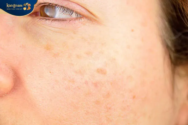 da nổi đốm nâu do viêm da cấp tính
