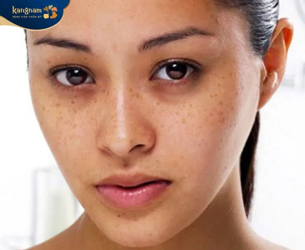 Đốm nâu trên da làm gương mặt giảm tính thẩm mỹ