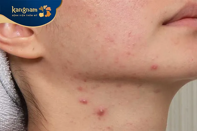 Không nặn mụn ở cổ khi mụn chưa chín