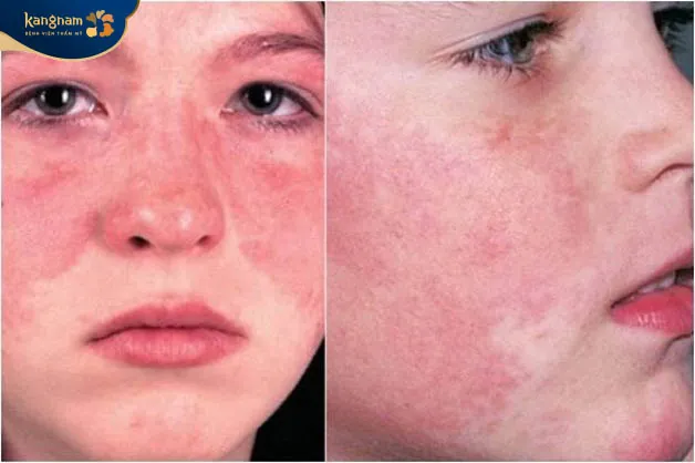 Lột da xong bị đỏ rát là phản ứng bình thường