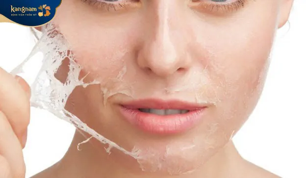 Lột da đỏ rát sau vài giờ sẽ biến mất