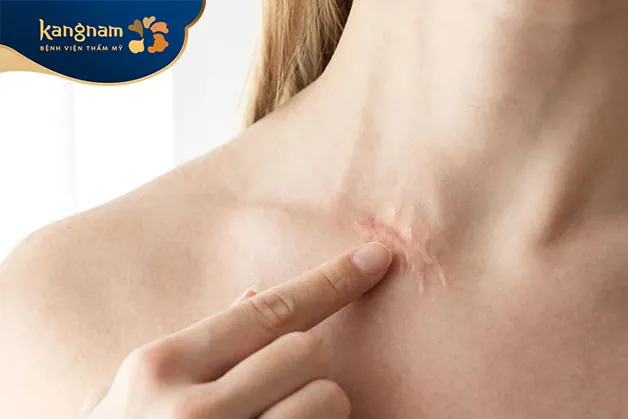 Sẹo hình thành thông qua quá trình làm lành tự nhiên của cơ thể