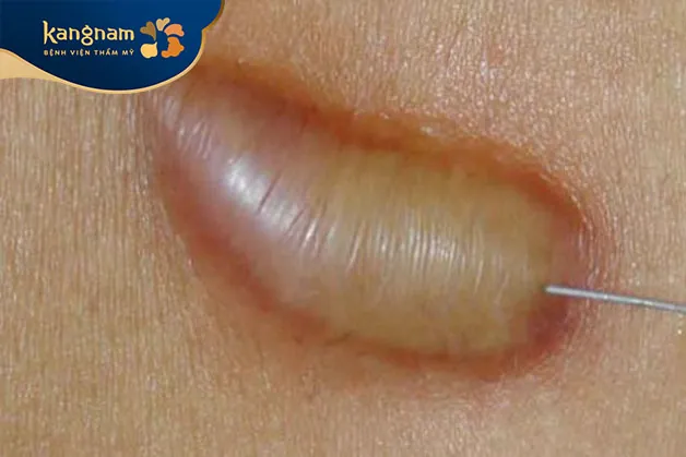 Tiêm corticosteroid trị sẹo lồi