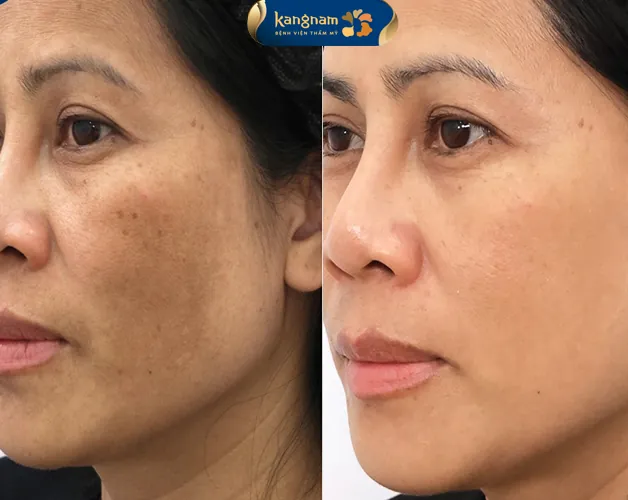 Khách hàng sau khi điều trị đốm nâu tại Kangnam, làn da sáng mịn, tươi trẻ và đều màu