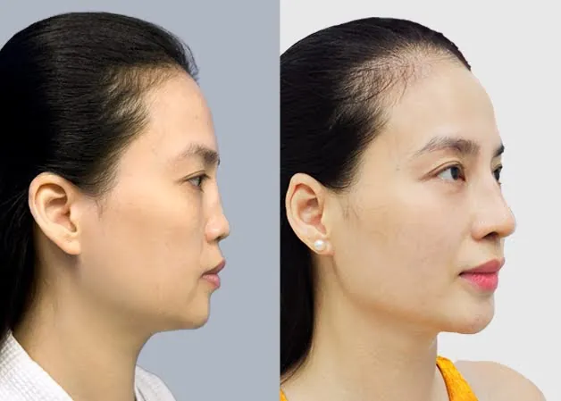 Bệnh viện Kangnam giải cứu mũi hỏng cho cô gái từng nâng mũi tại Hàn Quốc