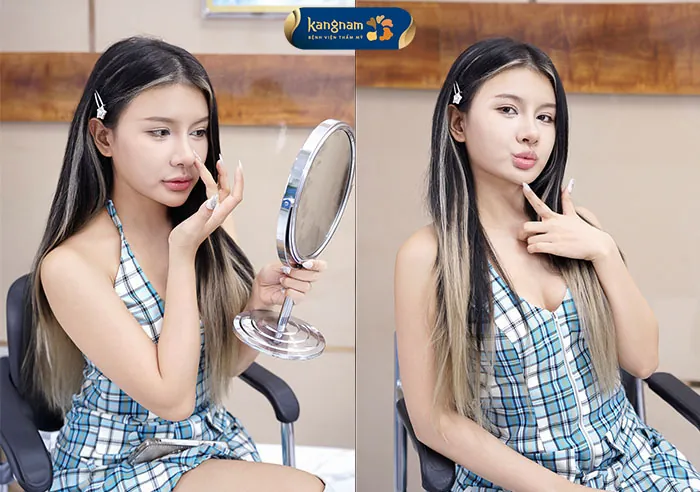 Xuân Ca thực hiện cắt mí, nâng mũi bởi bác sĩ Harvey Nguyễn