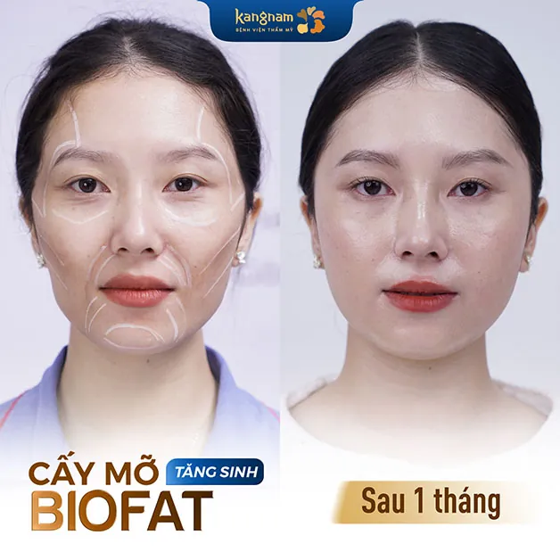Cấy mỡ tăng sinh BioFat duy trì kết quả lâu dài
