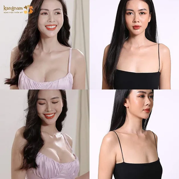 Chọn Kangnam để sở hữu bầu ngực vạn người mê