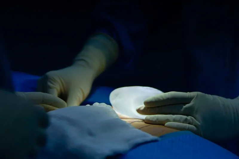 Kỹ thuật nâng ngực quyết định phần lớn đến kết quả