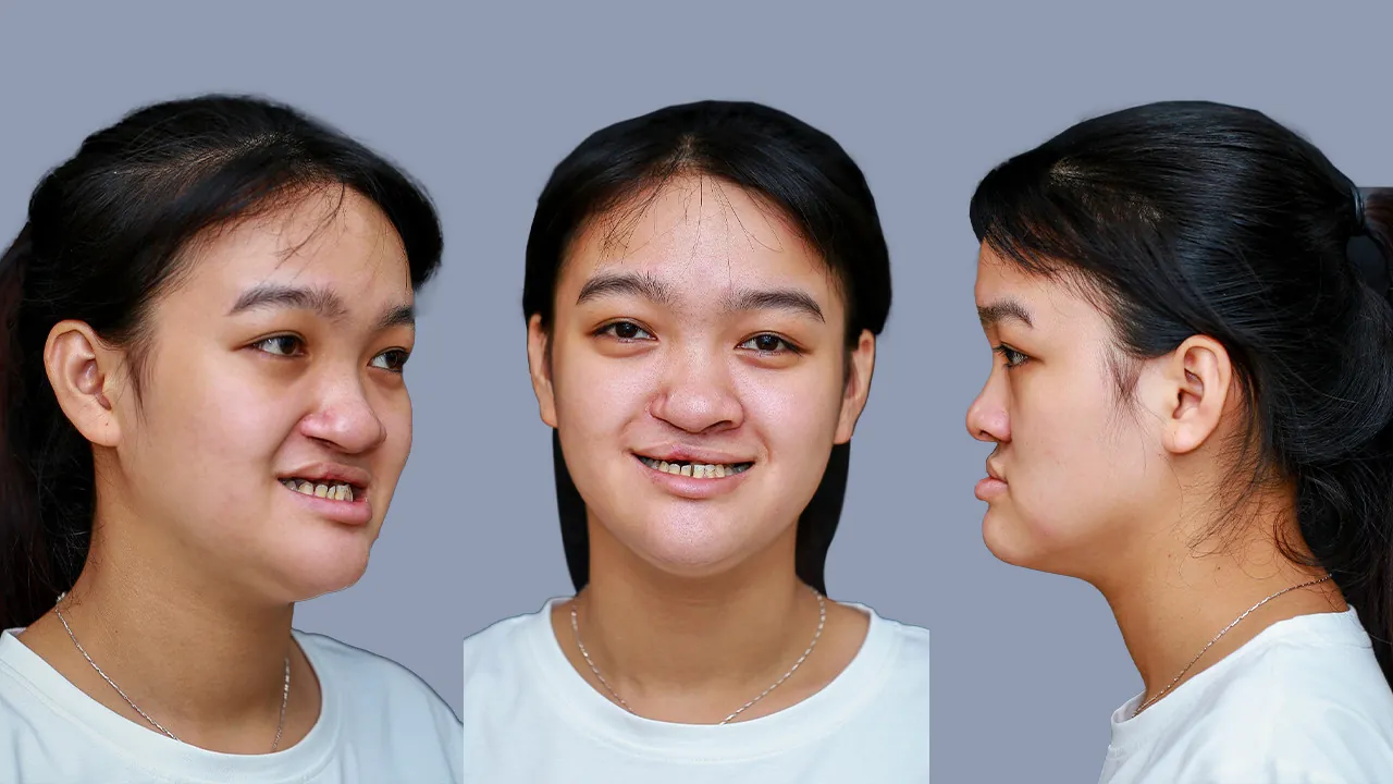 Thí sinh gặp vấn đề phức tạp về hàm mặt là trường hợp được ưu tiên