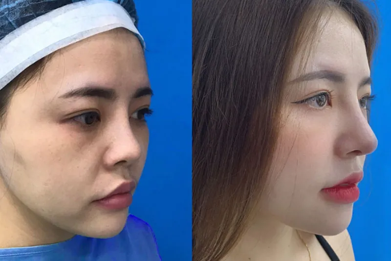 Cân nhắc nâng mũi nếu dáng mũi hiện tại nhiều khuyết điểm