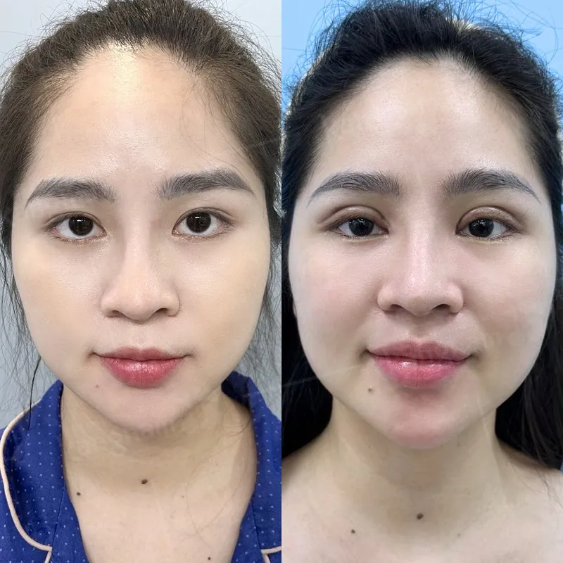 Nếp mí có thể duy trì được lâu dài