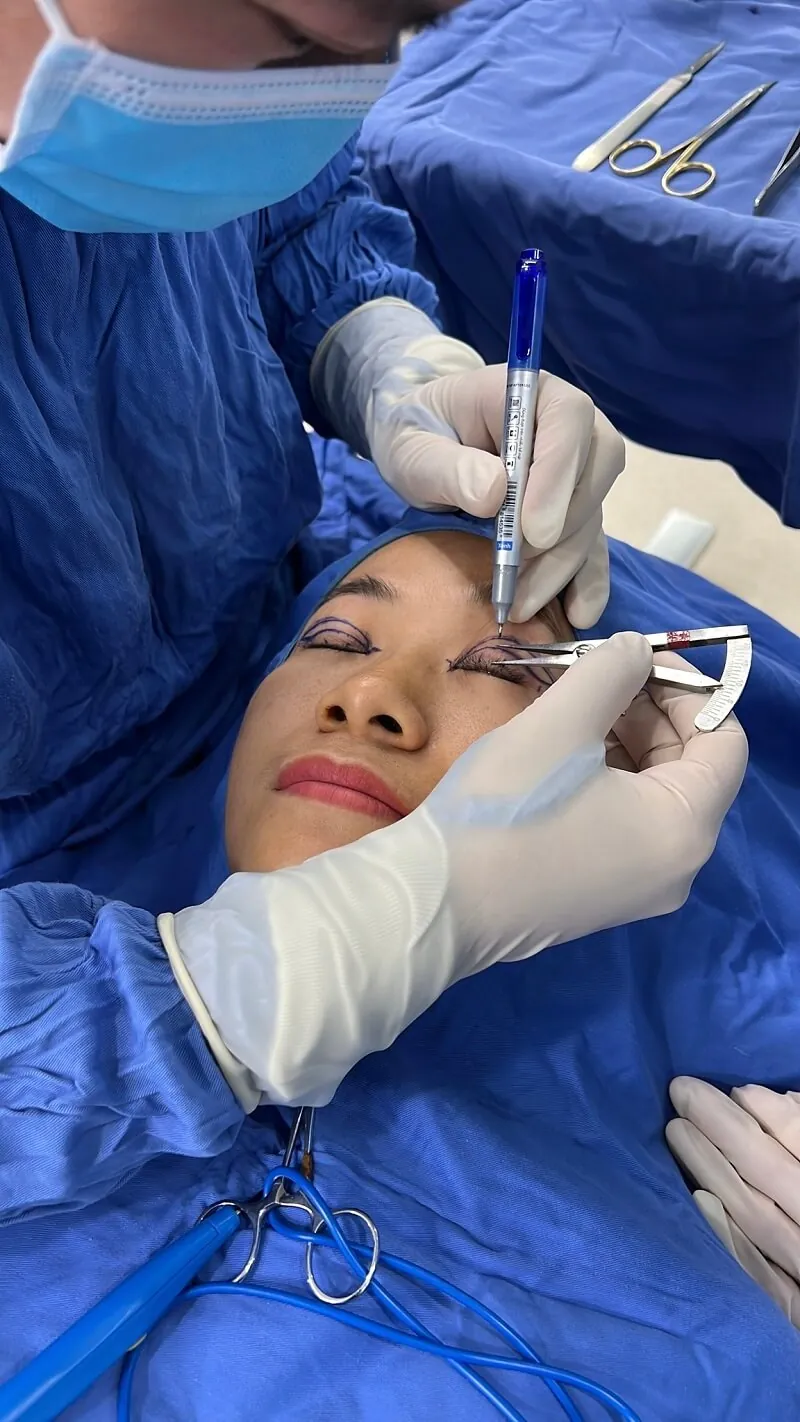 Phác thảo nếp mí phù hợp