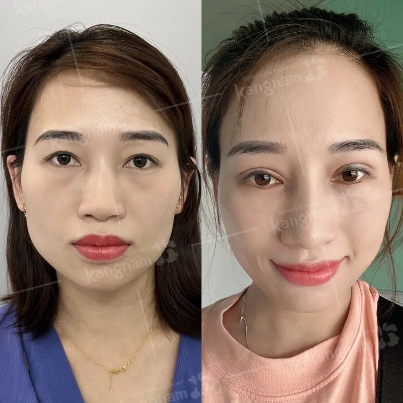 Khách hàng gặp tình trạng mí nhỏ, mí ẩn, mí lót