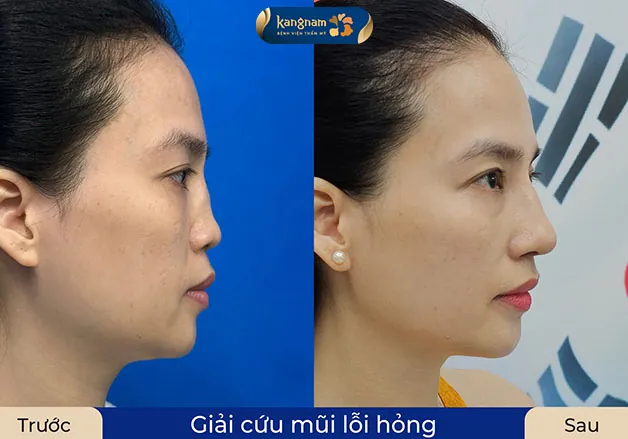 Mũi hỏng nặng, cần chỉnh sửa nhiều