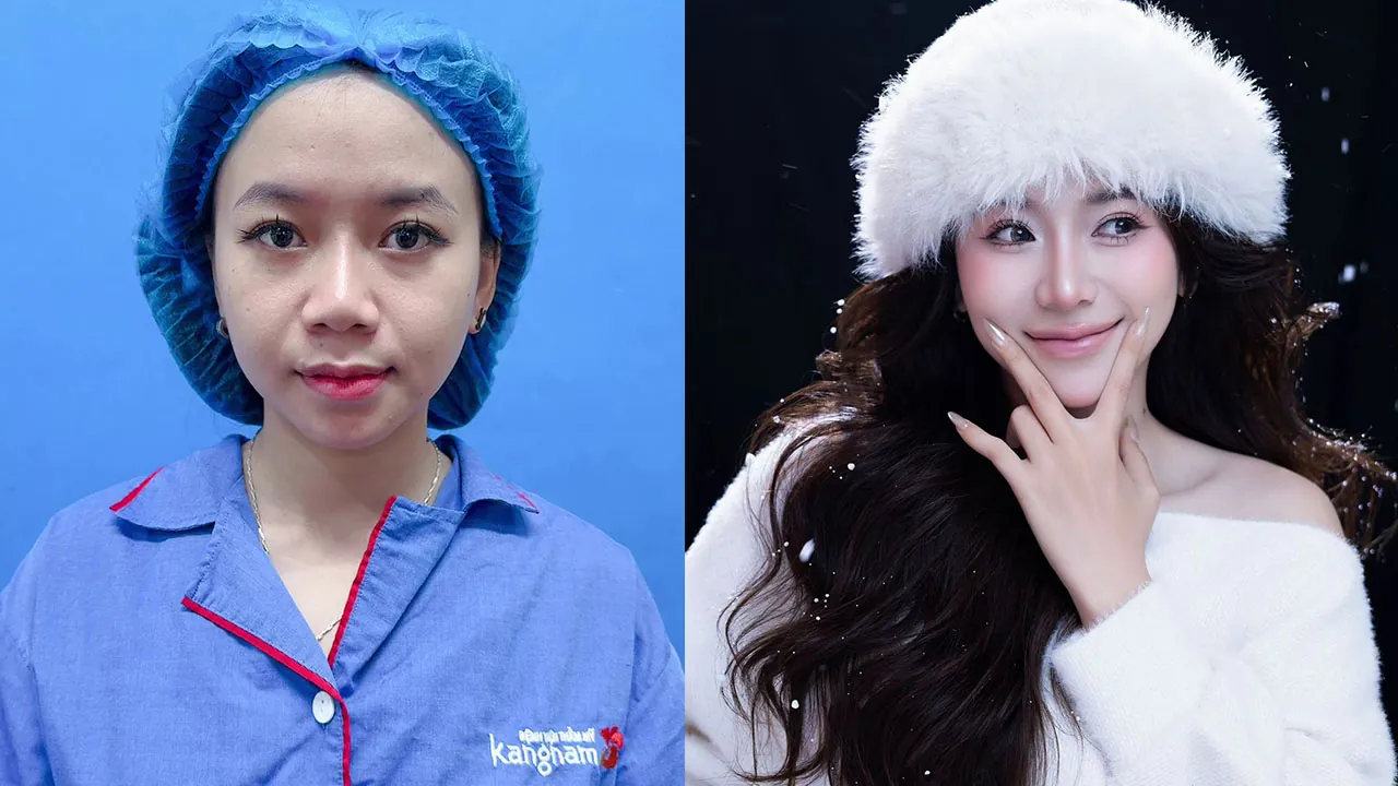 Nâng mũi - Nâng cấp bản thân để tự tin hơn