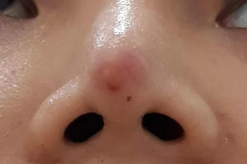 Dấu hiệu điển hình của tình trạng mũi không hợp sụn