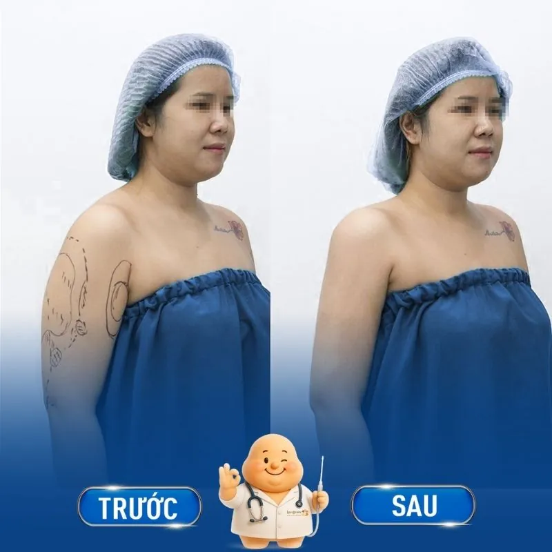 Phụ nữ sau sinh gặp tình trạng mỡ thừa, da chảy xệ