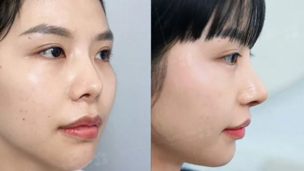 Ai làm được nâng mũi? Độ tuổi, thời điểm và những trường hợp nên – không nên