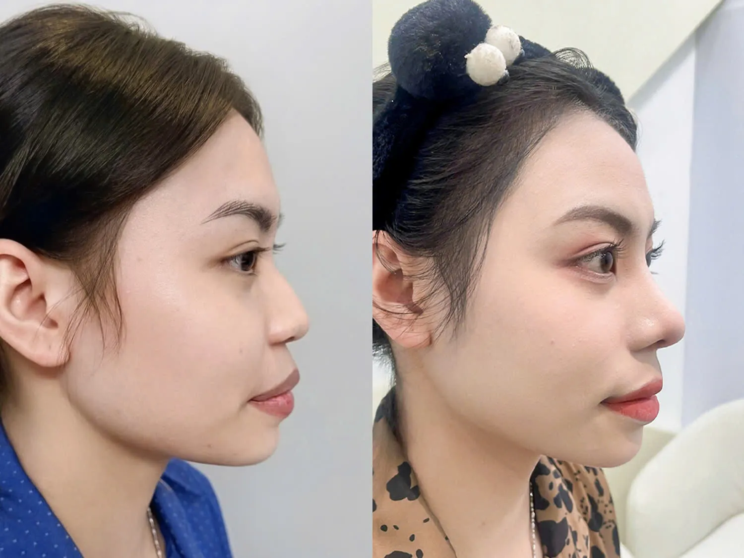 Khách hàng hài lòng với dáng mũi sau nâng