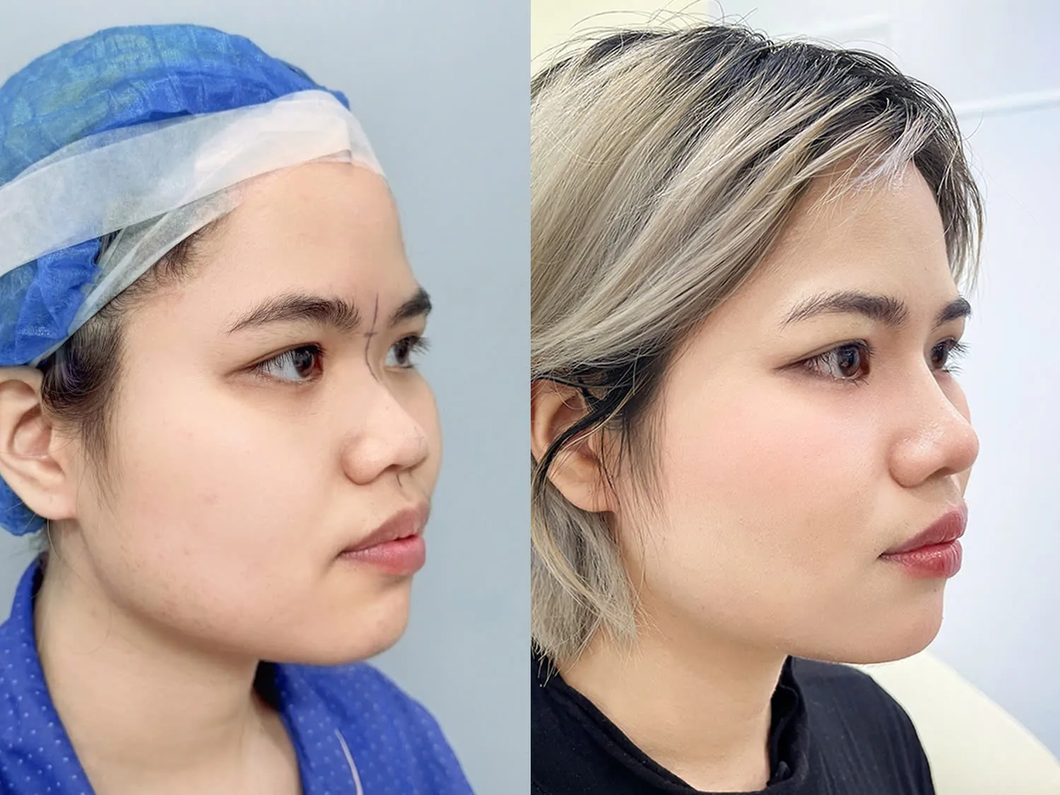 Dáng mũi ổn định, cân đối với gương mặt