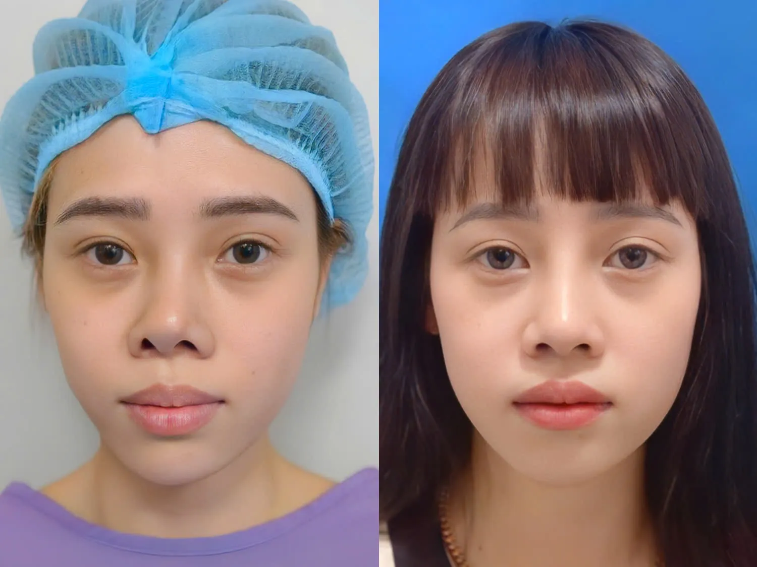 Tái cấu trúc mũi lệch sau phẫu thuật trước đó